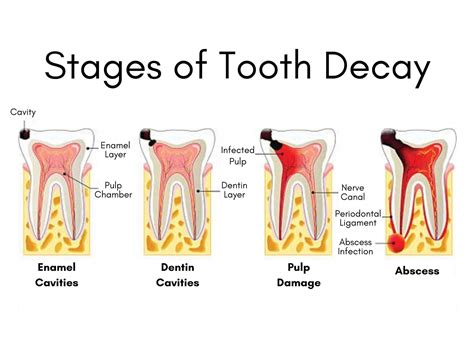 A Guide To Abscess Tooth Stages - Take Home Smile