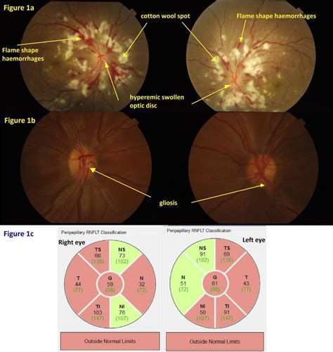 Figure From Lupus Nephritis With Visual Field Defect Secondary To