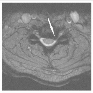 Axial image showing a left-sided osteophyte–disk complex encroaching on... | Download Scientific ...