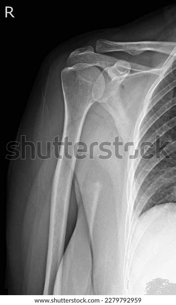 590 Shoulder X Ray Normal Images, Stock Photos, 3D objects, & Vectors ...