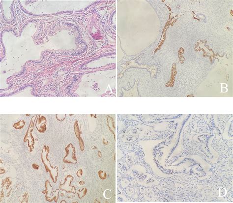 Frontiers Case Report A Rare Case Of Gastric Type Adenocarcinoma Of