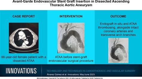 Avant Garde Endovascular Stent Graft Insertion In Dissected Ascending