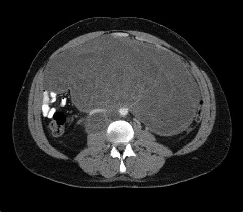 Growing Teratoma Syndrome Urology