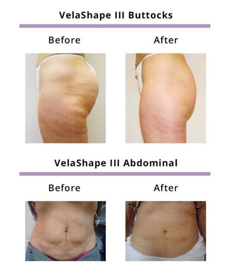 Body Contouring Cellulite Reduction Velashape