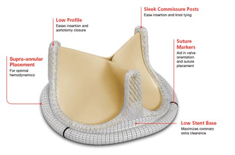 Carpentier Edwards Perimount Magna Ease Aortic Valve