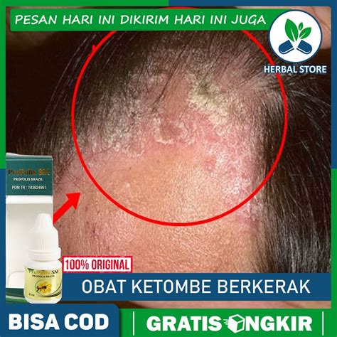 Jual Obat Ketombe Berkerak Kulit Kepala Kering Psoriasis Kulit