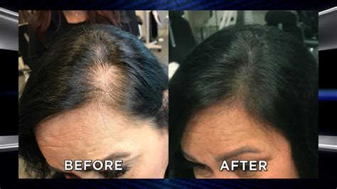 Could Microblading Your Scalp Help with Hair Loss? - YouTube