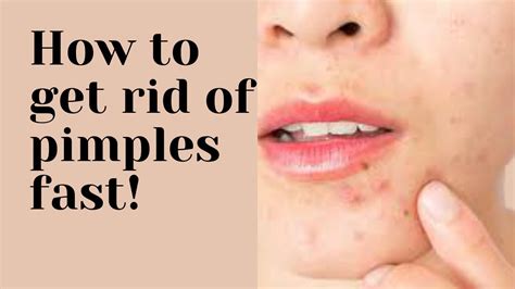 How To Get Rid Of Pimples Fast Easy Ways To Dry Out Your Acne In English With Subtitles Youtube