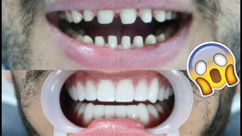 Oral Veneers Overview For Telegraph