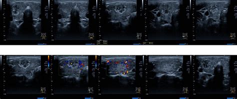 Close Up Report Ultrasound Neck And Thyroid Gland Medical Healthcare ...