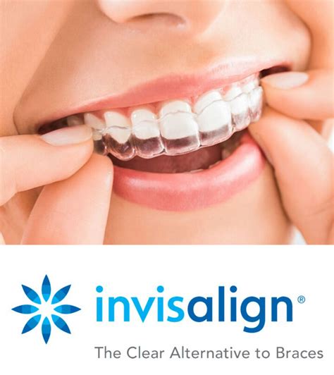 5 Fun Facts About Invisalign