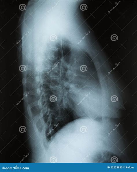 X Ray Image Of Human Healthy Chest Stock Photo Image Of Healthy