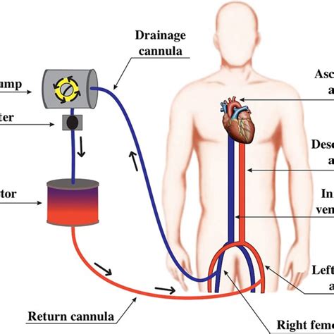 Diagram Of A Venovenous Extracorporeal Membrane Oxygenation Circuit