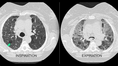 Air Trapping On The Chest X Ray And CT Scan YouTube