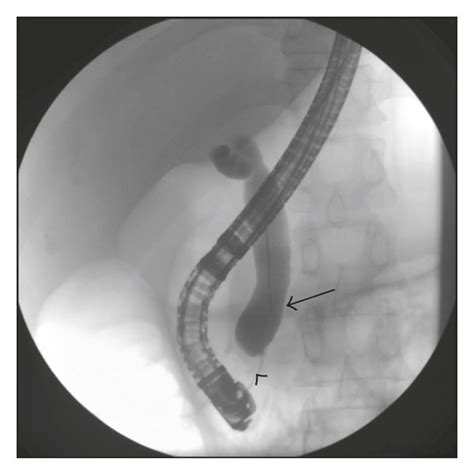 A Ercp With Cholangiogram Showing Dilated Common Bile Duct Pointed Download Scientific