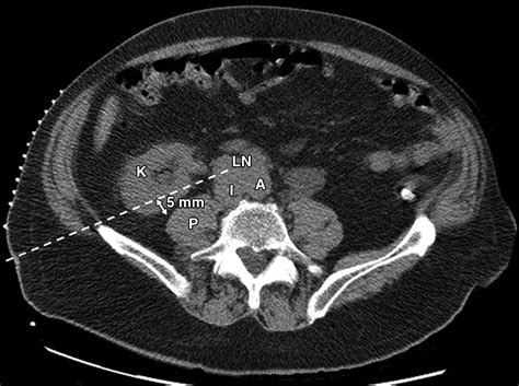 Hydrodissection Assisted Image Guided Percutaneous Biopsy Of Abdominal And Pelvic Lesions