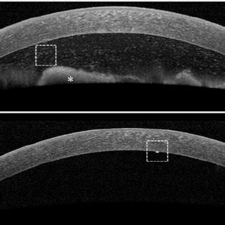 a The anterior segment optical coherence tomography (AS-OCT) performed ...