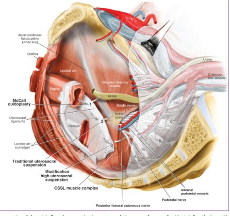 Figure 6 From Surgical Treatments For Vaginal Apical Prolapse