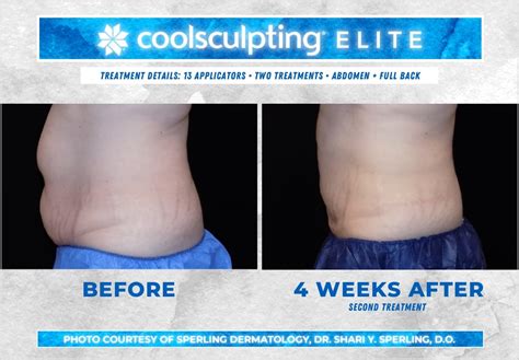 Before After Photos Of Coolsculpting Treatment Results