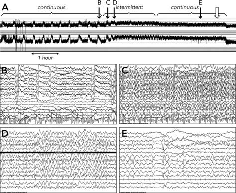 The Direct Role Of Deep Brain Stimulation Dbs In Treatment Response Download Scientific