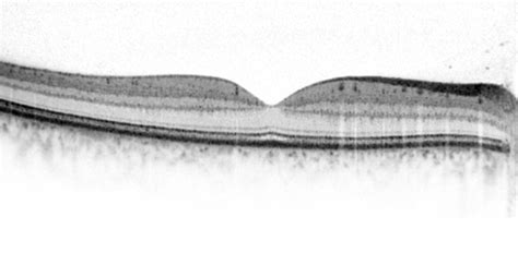 Retinal examinations