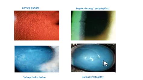 Fuchs endothelial dystrophy mahfuz.pptx