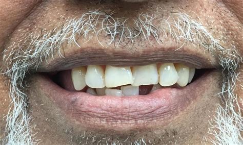 Tooth Extraction Before And After Photo Dentist Royal Palm Beach