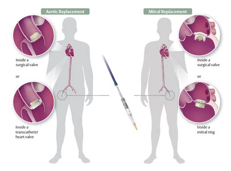 Transcatheter Aortic Valve Replacement Apollo Cvhf Heart Institute