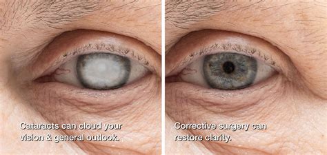 Cataract and lasik surgery