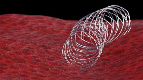 Nitinol Medical Stent 3d Model Cgtrader