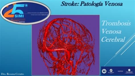 Trombosis Venosa Cerebral