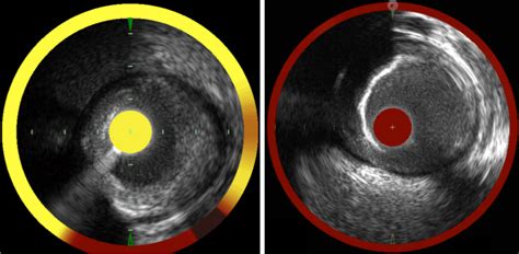 Combined NIRS IVUS Images The Current Clinically Available NIRS Device