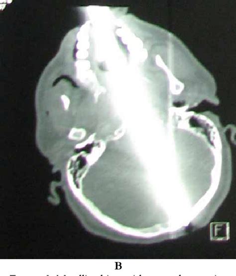 Figure 1 From A Rare Case Of Severe Craniocerebral Trauma With