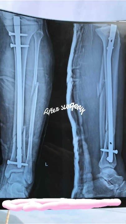 Tibia And Fibula Fracture Recovery Journey Shorts Distal Fracture