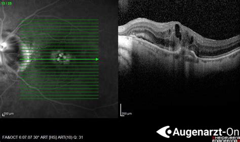 Feuchte Makuladegeneration Atlas Der Augenheilkunde