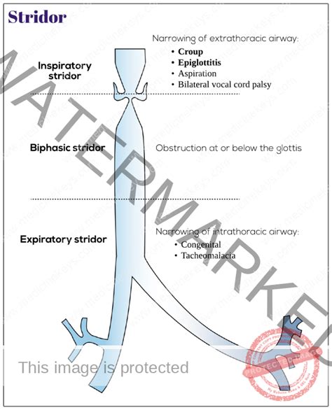 Stridor Medicine Keys For Mrcps