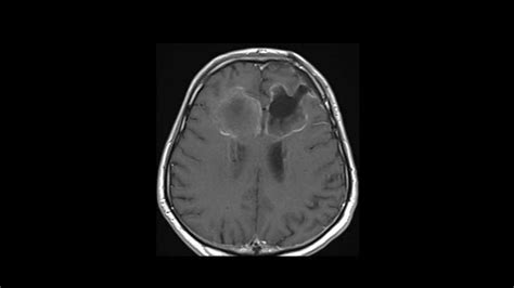 Glioblastoma Neuro Mr Case Studies Ctisus Ct Scanning