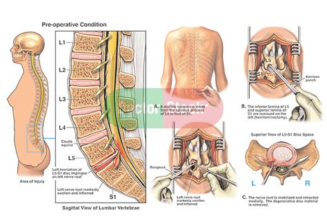 L5 S1 Disc Herniation With Hemilaminectomy And Discectomy Procedure