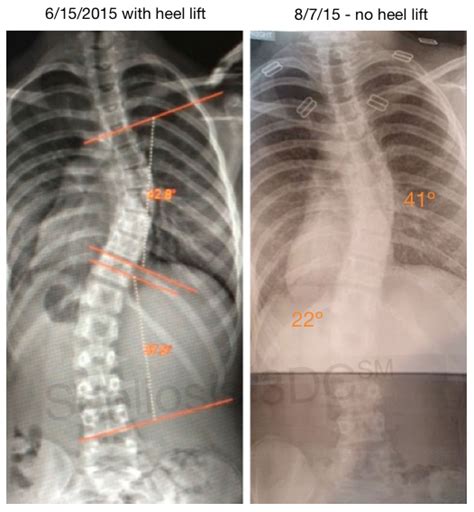 Heel Lift For Scoliosis Leg Length Discrepancy LLD