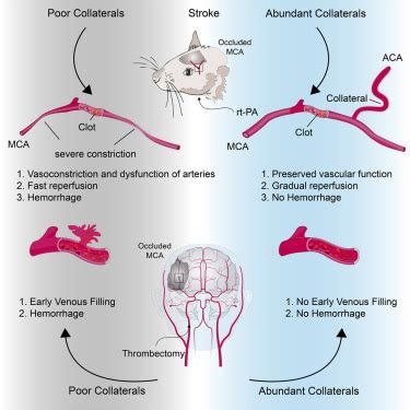 Leptomeningeal Collaterals Regulate Reperfusion In Ischemic Stroke And