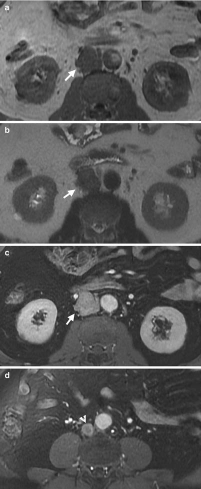 Retroperitoneal Diseases Radiology Key