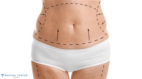 Tummy Tuck In Turkey Medical Center Turkey