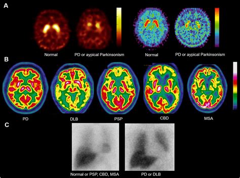 Single Photon Emission Computed Tomographypositron Emission Tomography Molecular Imaging For