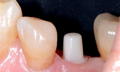 Implantes No Metalicos Que Son Los Implantes Dentales De Zirconio