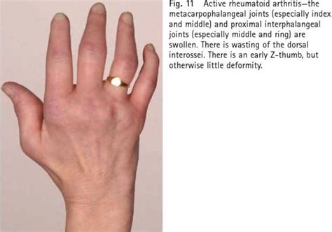 Rheumatoid Arthritis Mcp Joint Involvement Early Z Thumb Rheumatoid Arthritis Arthritis