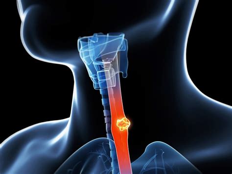 Esophagus Cancer Radiology