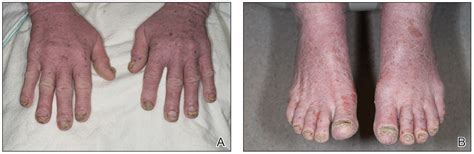 Nail Irregularities Associated With Sézary Syndrome MDedge