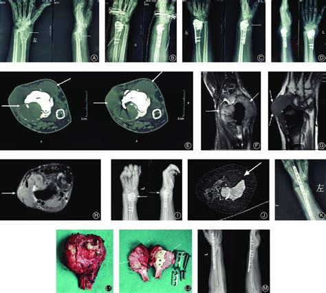 A Year Old Female With A Recurrent Left Distal Radius Gctb A C