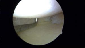 Recovery After Meniscal Tear Surgery – Howard J. Luks, MD