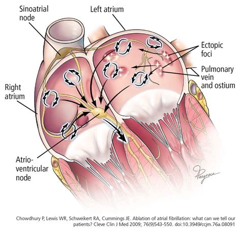 Atrial Fibrillation Ablation